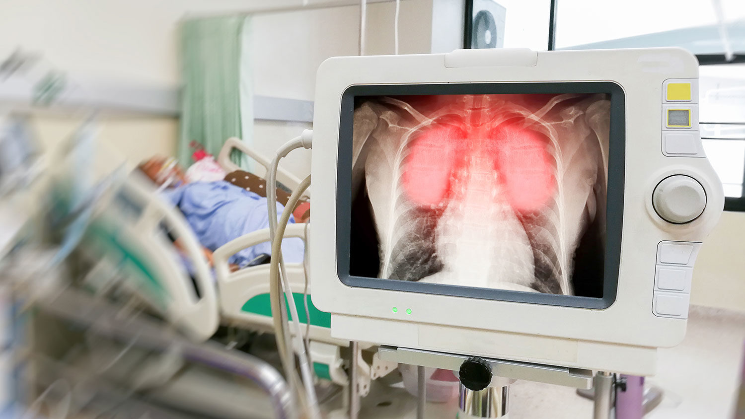 У Запорізькій ОДА розповіли, скільки апаратів штучної вентиляції легенів є в лікарнях області