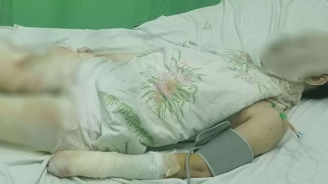 В Запорожской области из-за пьяного супруга жена получила 53% ожогов тела: ее готовят к операции, – ФОТО, ВИДЕО
