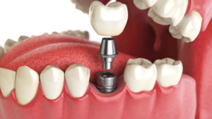 Протезирование или имплантация зубов: чем отличаются и что лучше