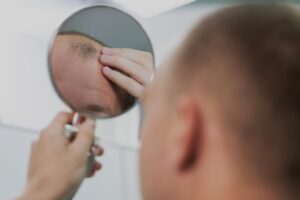 Пересадка волосся: естетична процедура чи необхідність?