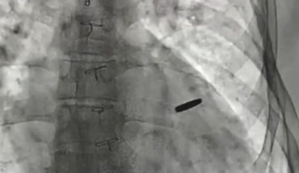 Украинский парамедик три года жил в русском плену с пулей в сердце.