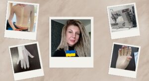 Як Ольга Петрюк із Запоріжжя створює одяг, що допомагає відновлюватися після опіків
